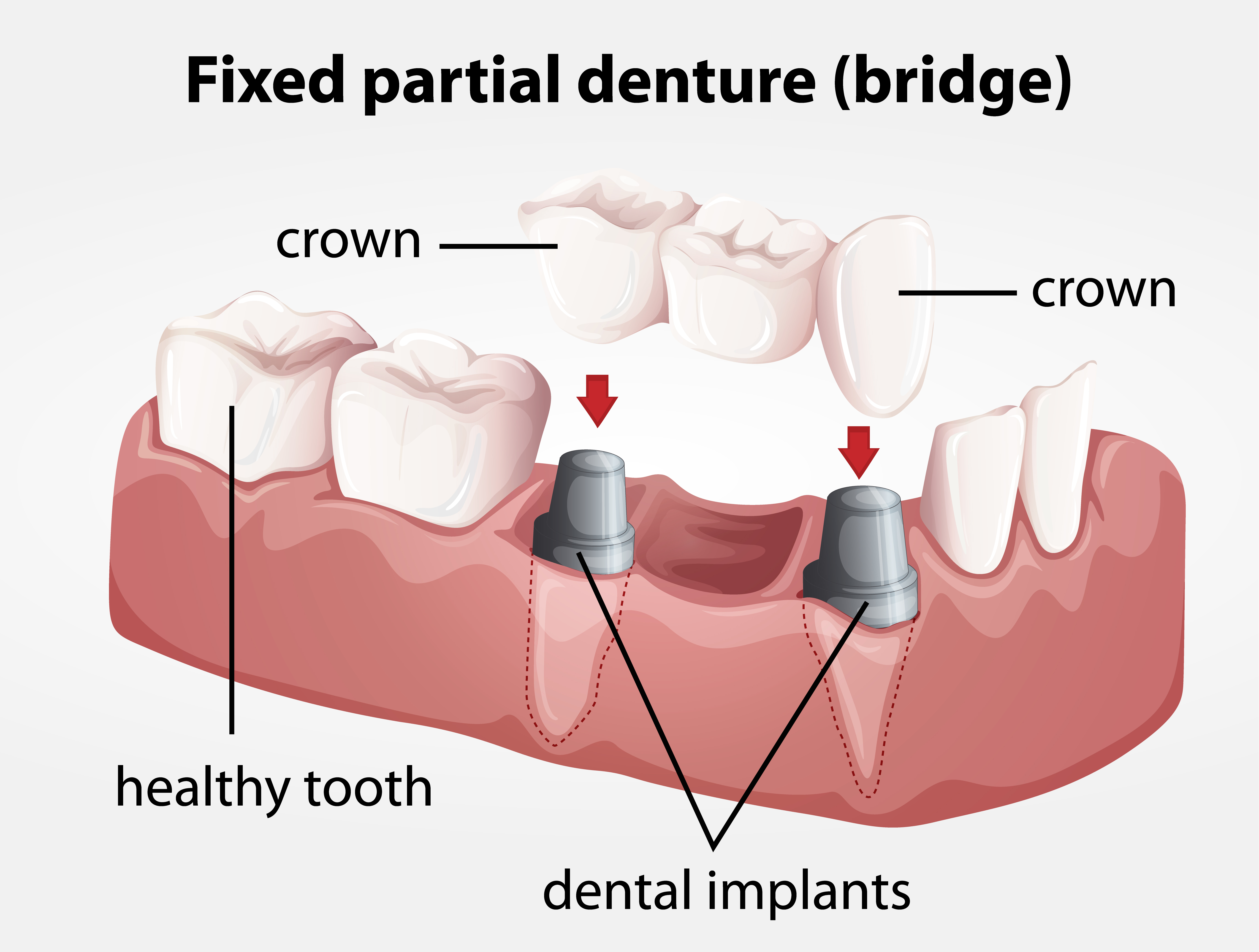 Porcelain Bridge | Dental Bridge | Reconstructive Dentistry Eugene