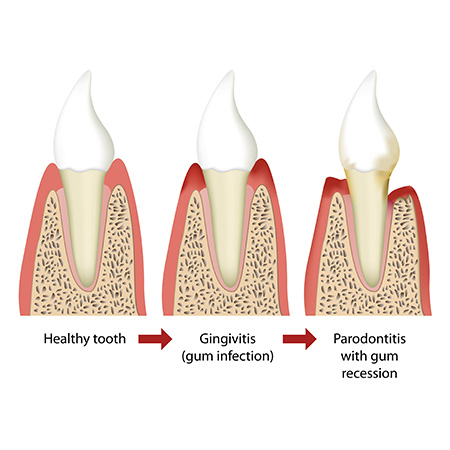 Periodontal Therapy | Reconstructive Dentist | Periodontal Disease