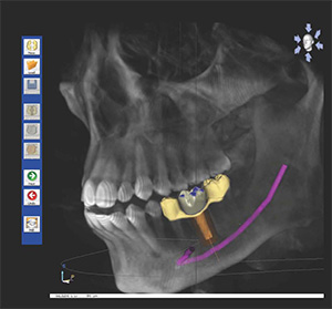 Eugene dentist | implant placement | Dr Work