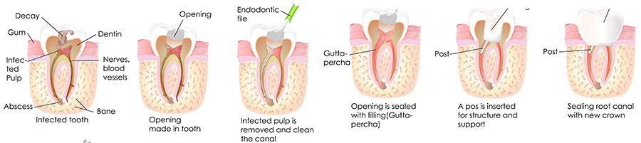 Root Canal Eugene | Dental Root Canal | Tooth Pain | Reconstruct